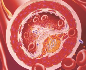 Cholesterol