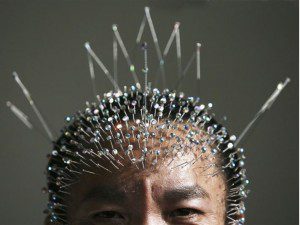acupuncture
