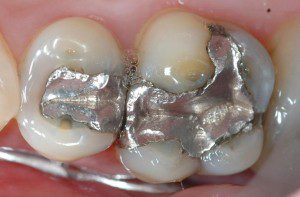 mercury-fillings