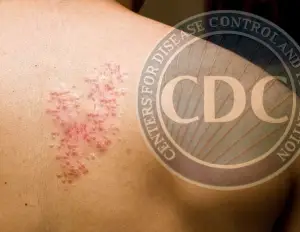 CDC