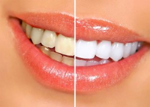 white_teeth