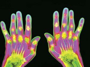 Rheumatoid_Arthritis