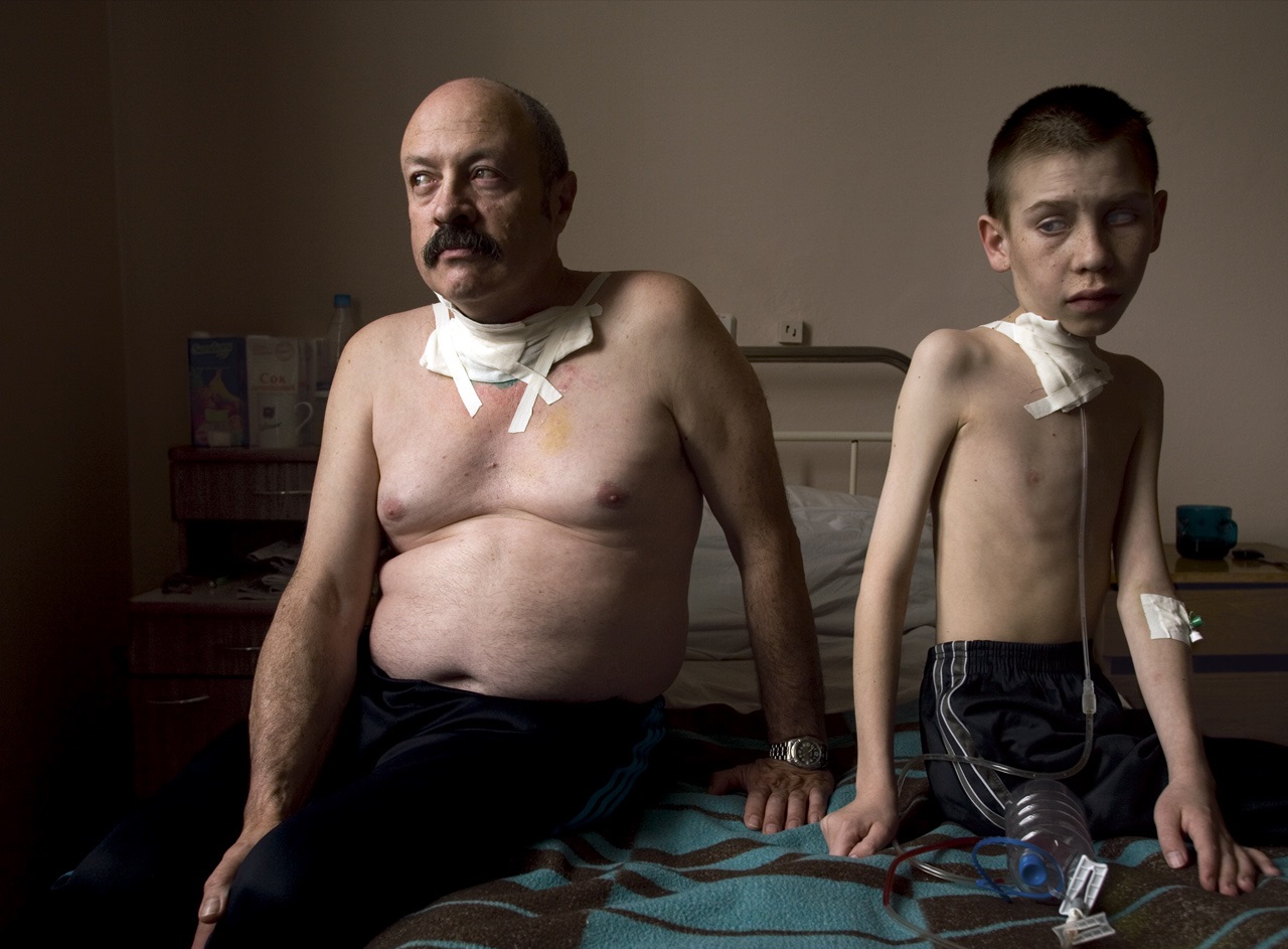 Cancer, Coverups and Contamination - The Real Cost of Nuclear Energy - Chernobyl Victims After Thyroid Cancer Surgery