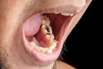 Amalgam Fillings Release Mercury Vapor Into Your Body 24-7
