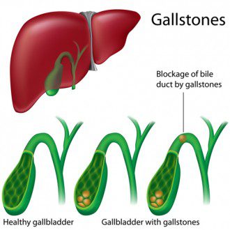 gallstones