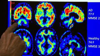 Scientific Breakthrough - Alzheimer’s Ultrasound Therapy Fully Restores Memory Function in Mice - w
